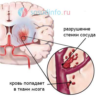 Як відомо,   артеріальною гіпертензією   страждає велика частина населення всієї земної кулі після 40-50 років