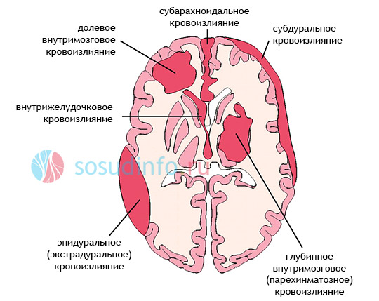 Субарахноїдальний крововилив;   Паренхматозное крововилив;   Внутрішньошлуночкові крововиливи;   Суб-і епідуральний крововилив (нетравматичний)