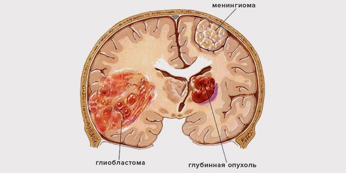 Гліобластоми відрізняються ступенем злоякісності, яка визначається шляхом біопсії (дослідження клітин пухлини в лабораторних умовах)