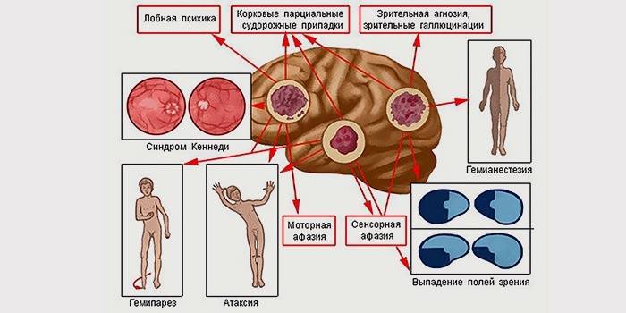 запамороченнями;   порушенням зору;   епілептичними припадками;   сонливістю;   онімінням кінцівок