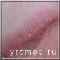 Гранули Фордайса - це шкірні прояви в куточках рота, на слизовій ротової порожнини, на голівці статевого члена, на статевих губах схожі на маленькі, білі точки