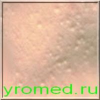 Також себорейниє кісти не є заразними і не несуть ніяких ускладнень, хоча і досить часто зустрічаються в практиці венерологів і дерматологів