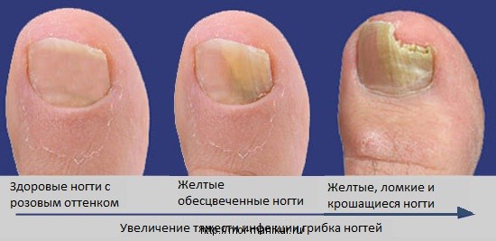 Все неодноразово чули про таке захворювання, як грибкове ураження нігтів і його страшні наслідки
