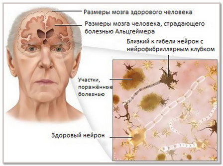 Фахівці стверджують, що найчастіше розвиток хвороби Альцгеймера проявляється у людей з низьким інтелектуальним рівнем розвитку, що виконують некваліфіковану роботу