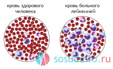 Залежить це від форми лейкозу