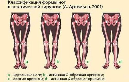 Для визначення типу кривизни проведіть нескладний тест: