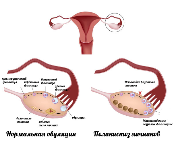 При гормональному дисбалансі (полікістоз), описаному вище, не відбувається зростання домінантного фолікула, достатнього для виходу яйцеклітини, він перезріває і заповнюється рідиною, тобто овуляції не відбувається і так кожен цикл