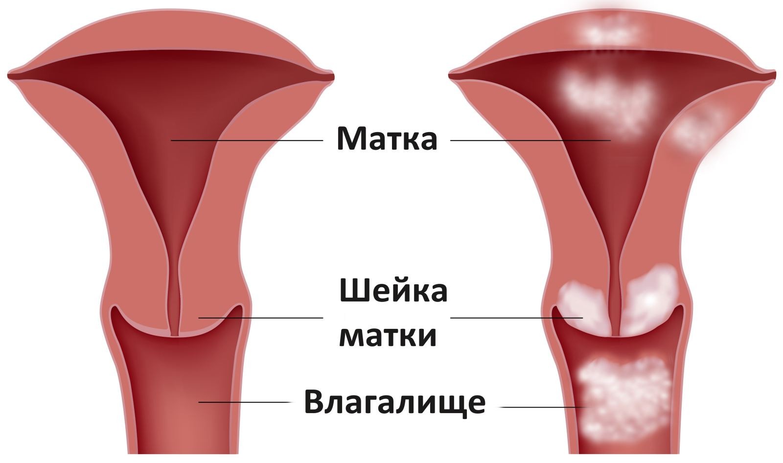 Що таке рак матки: загальні відомості про хвороби   Рак матки   - злоякісне новоутворення, яке розвивається з тканин матки і може поширюватися в інші органи