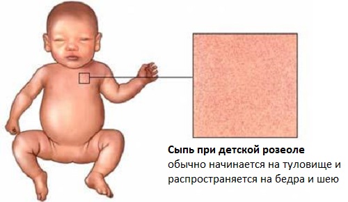 Дитяча розеола ( «раптова екзантема», «шоста хвороба» і ін