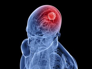 Запалення кори головного мозку - це менінгіт, основною причиною якого є такі інфекції, як менінгокок, пневмокок, гемофілюс інфлуенца і інші, менш поширені інфекції