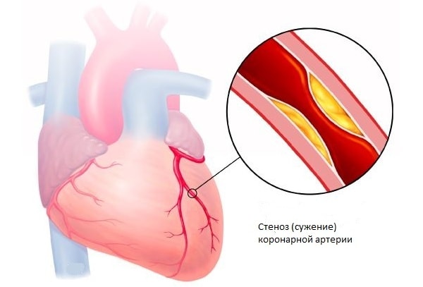 Основною причиною стенокардії є   атеросклероз