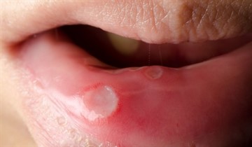 Відрізнити стоматит на   верхній губі   або нижньої можна за такими ознаками: