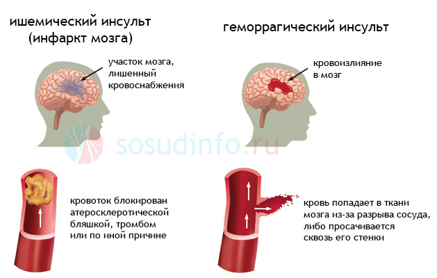 Ішемічний інсульт протікає більш сприятливо, а при геморагічному швидко наростає набряк і внутрішньочерепна гіпертензія, тому смертність значно вища в разі гематом