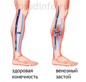 Так чому при даних патологіях сверблять вени