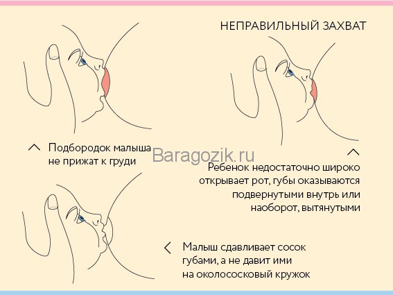 Неправильний Захоплення соска Малюком при годуванні