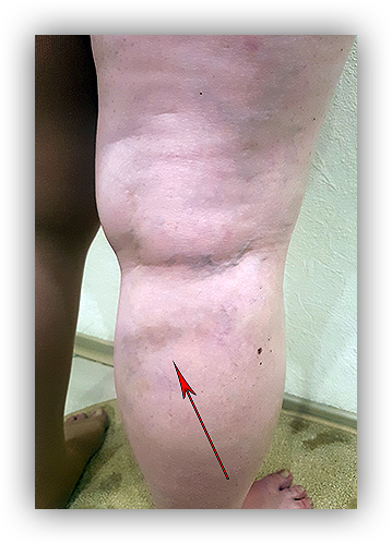 Маттінг (матування шкіри) або «судинна серпанок» (відзначається в 20-30% випадків) це поява темно-сірого «ореола» навколо склерозованих вен або утворення дрібних телеангіоектазій