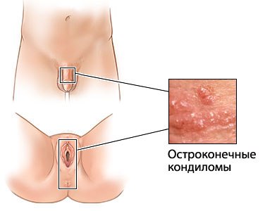 Кондиломи - це доброякісні пухлини шкіри, що зовні нагадують цвітну капусту